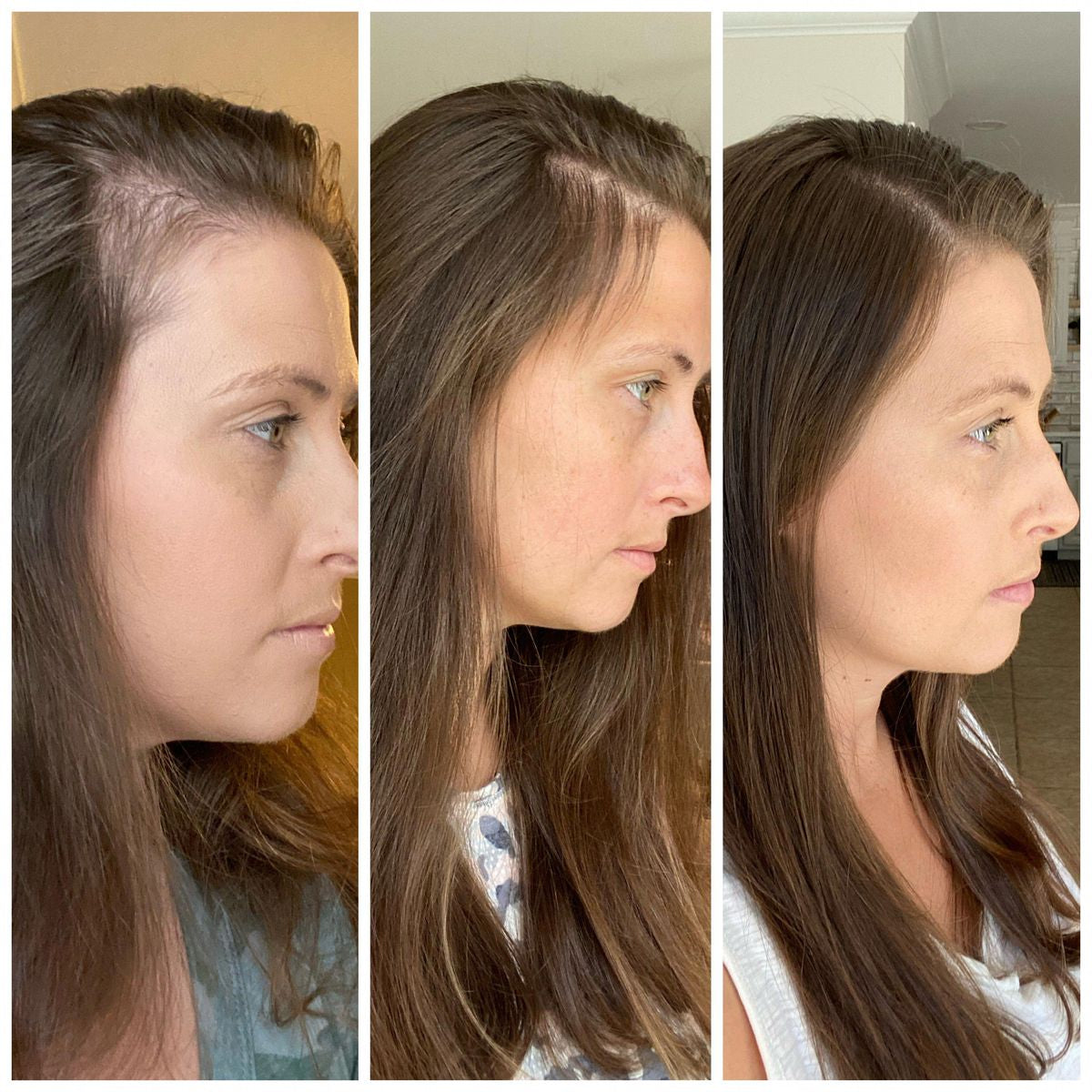 REVITALIZZA® Serum Roll-On — Regrow Every Inch — Real, Visible Hair Growth Across Your Scalp in Just 12 Weeks