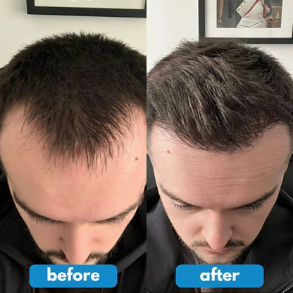 REVITALIZZA® Serum Roll-On — Regrow Every Inch — Real, Visible Hair Growth Across Your Scalp in Just 12 Weeks